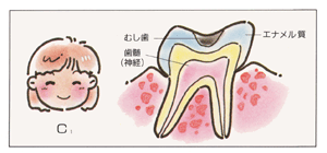 むし歯はどうしてできるのでしょう？