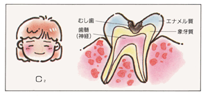 むし歯はどうしてできるのでしょう？