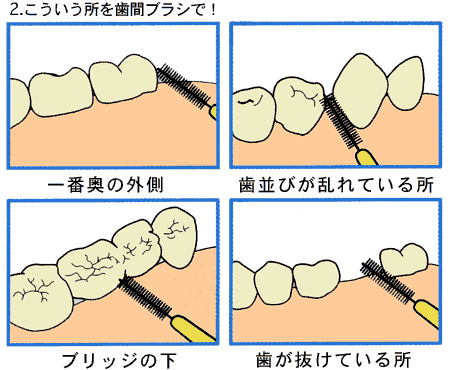 歯間ブラシ